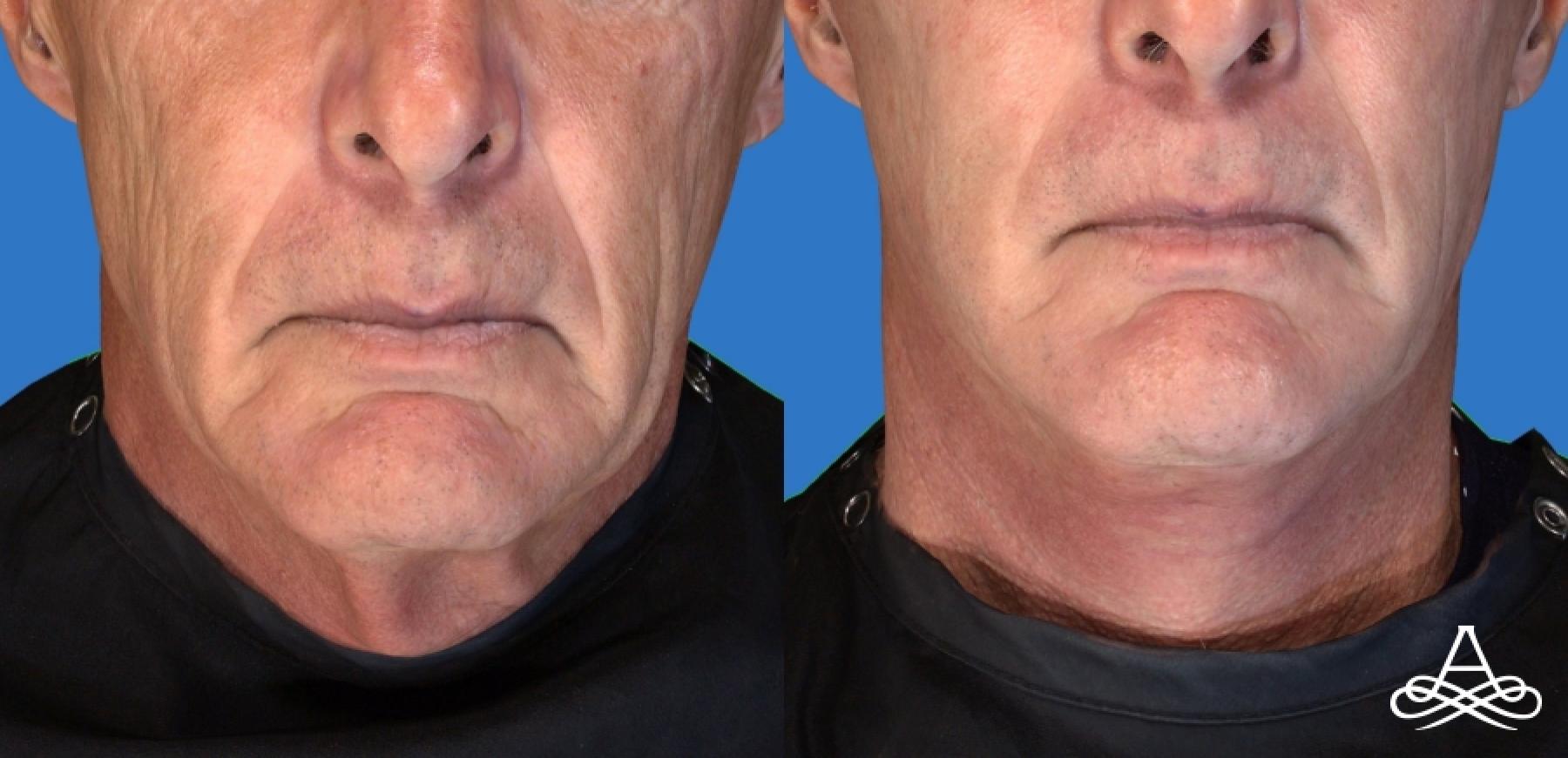 Facelift: Patient 4 - After  