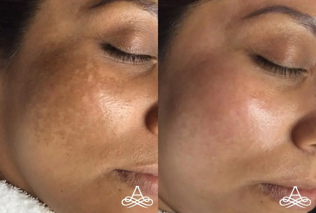 Lasers For Brown Pigment Problems: Patient 1 - Before and After  