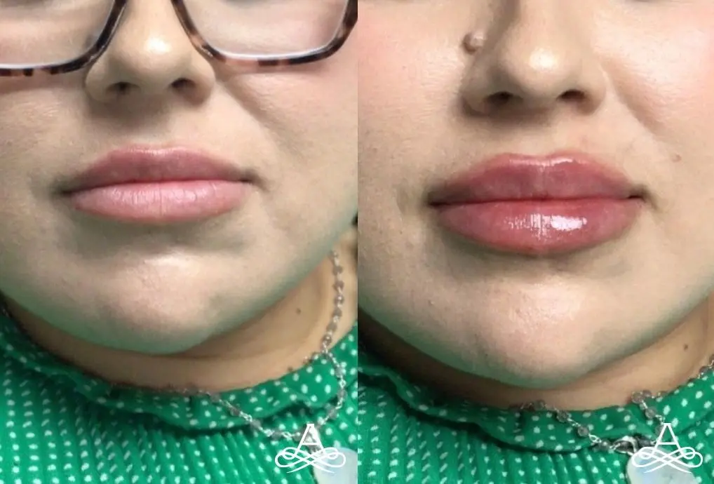 Lip Augmentation: Patient 1 - Before and After  