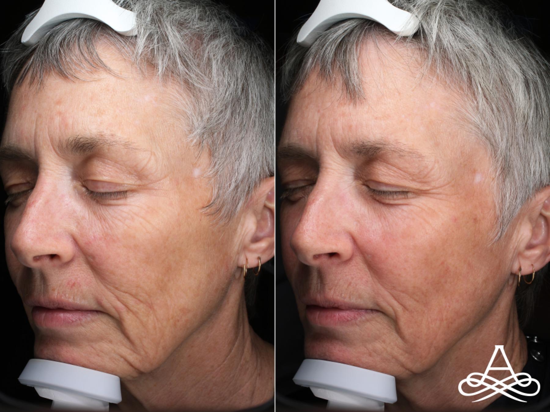 CO2 Laser Resurfacing: Patient 5 - Before and After  