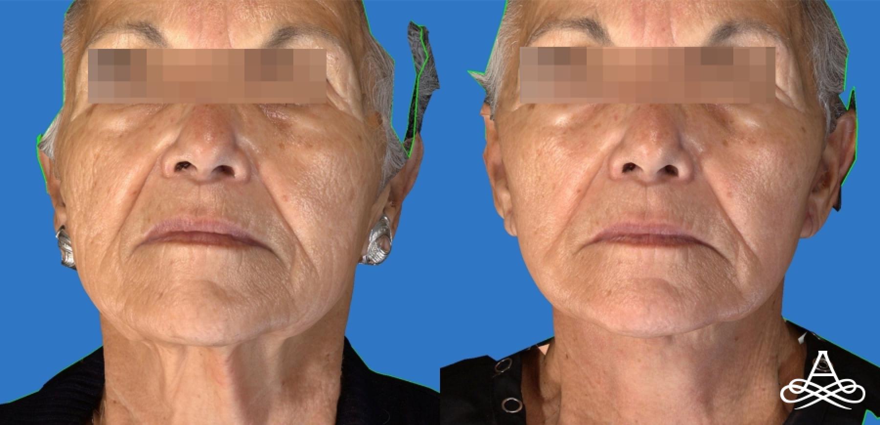 Facelift: Patient 8 - Before and After  
