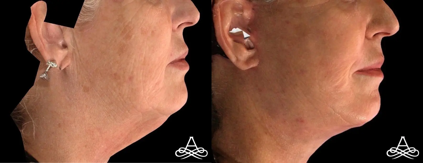 Neck Lift: Patient 1 - Before and After  