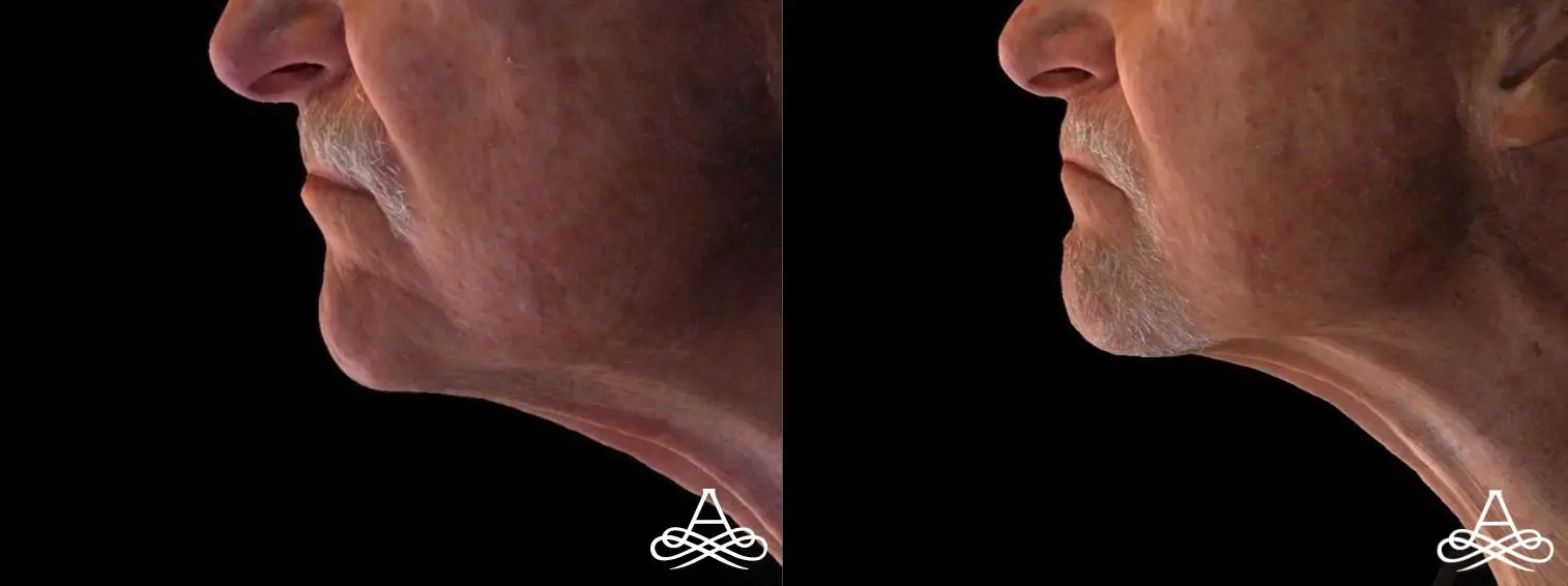 Neck Lift: Patient 2 - Before and After  