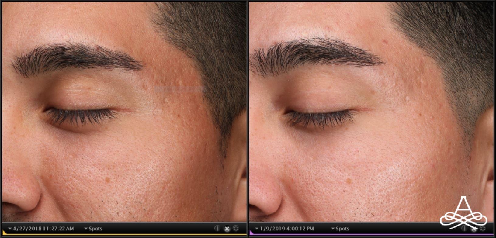 Acne Scars: Patient 7 - Before and After 1