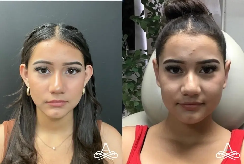 Otoplasty: Patient 3 - Before and After  
