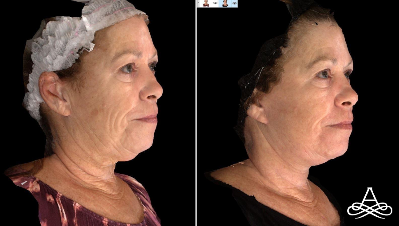 Bellafill®: Patient 8 - Before and After 2