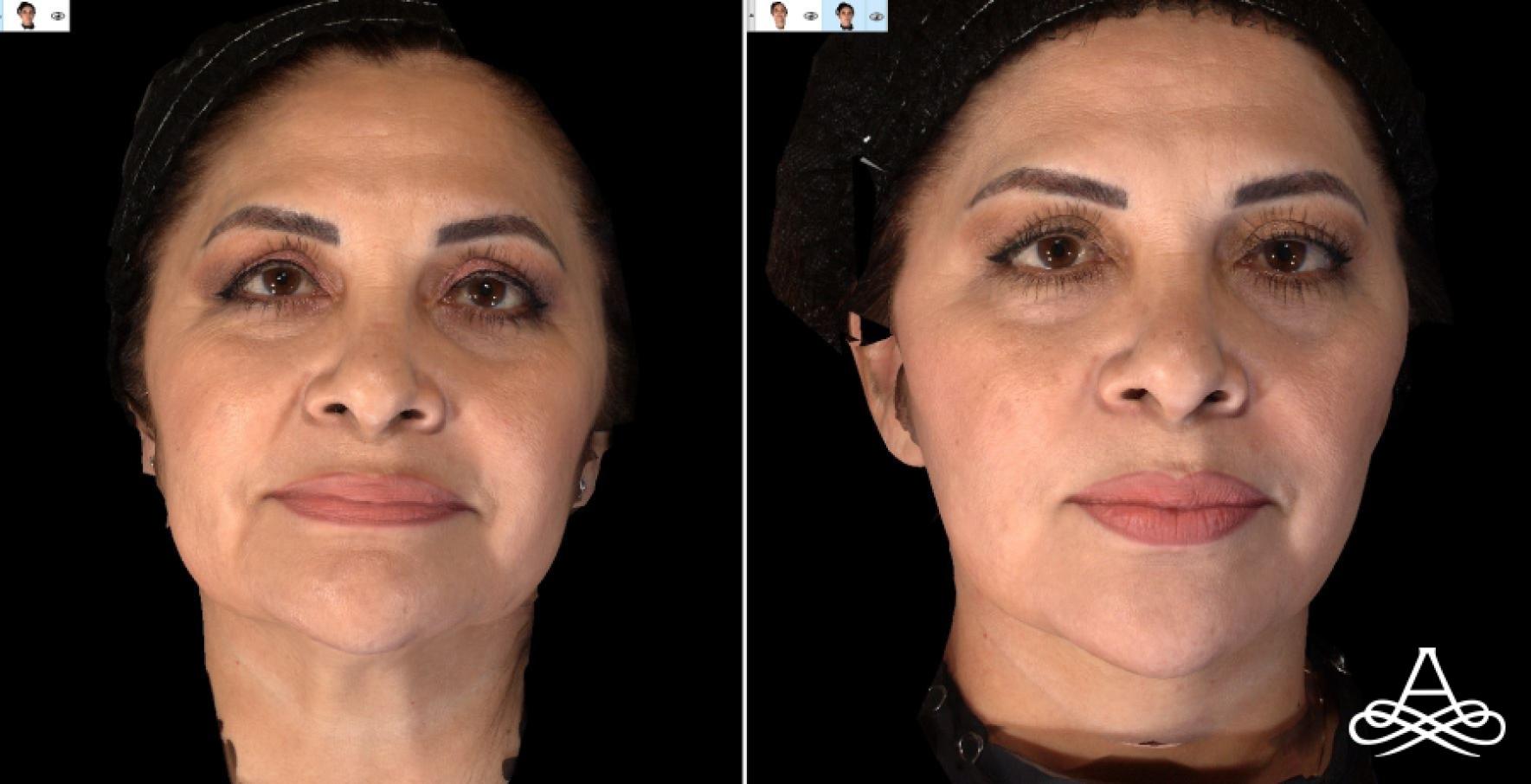 Bellafill®: Patient 4 - Before and After  