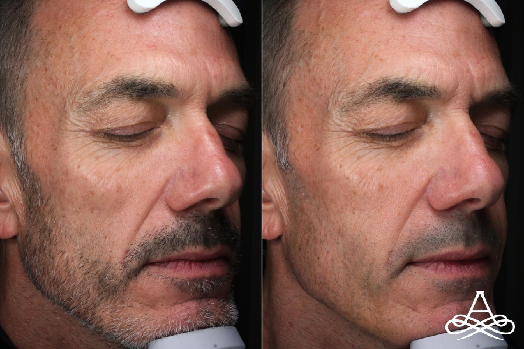 Bellafill®: Patient 1 - Before and After  