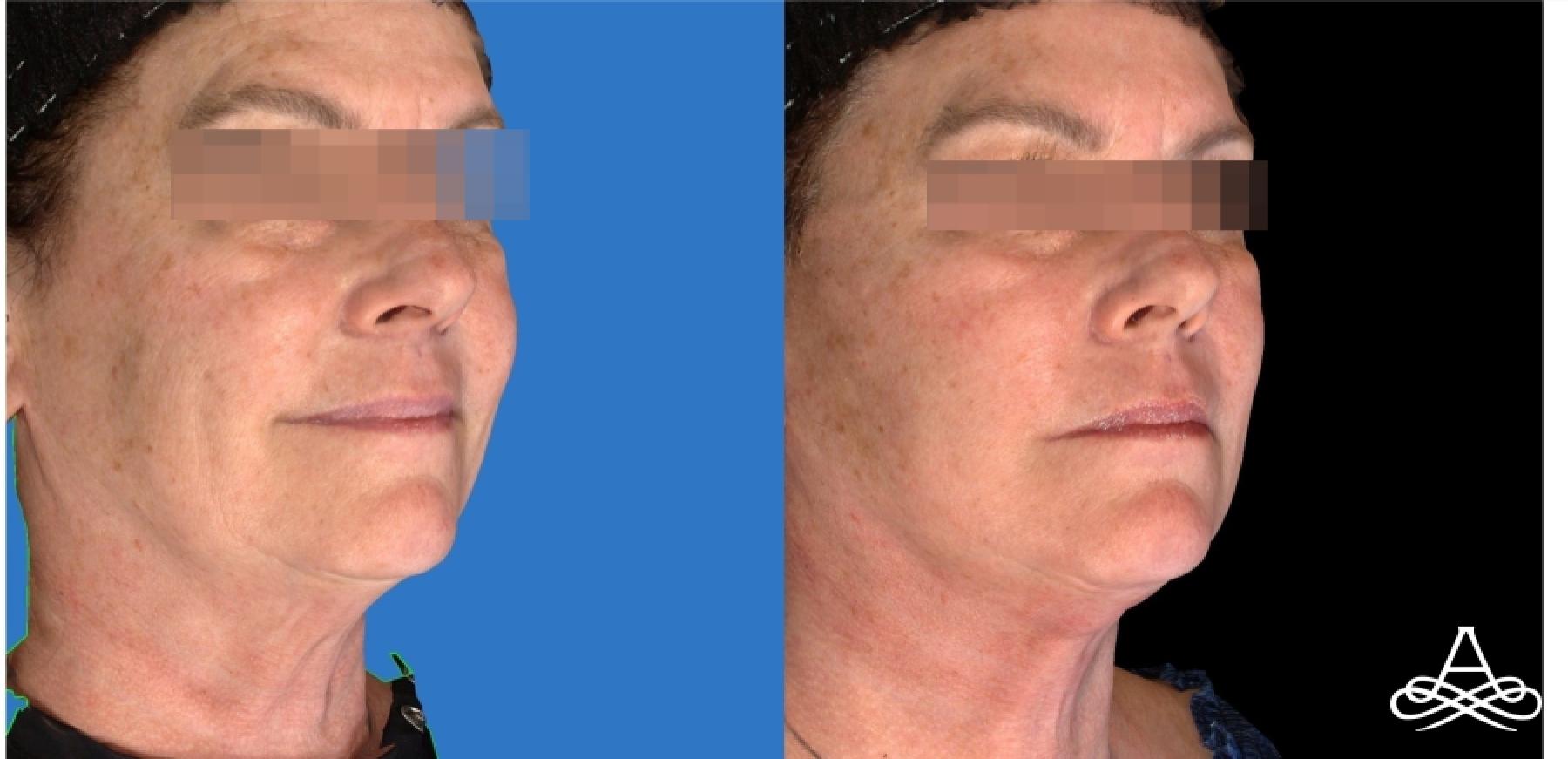 Facelift & Neck Lift: Patient 2 - Before and After  