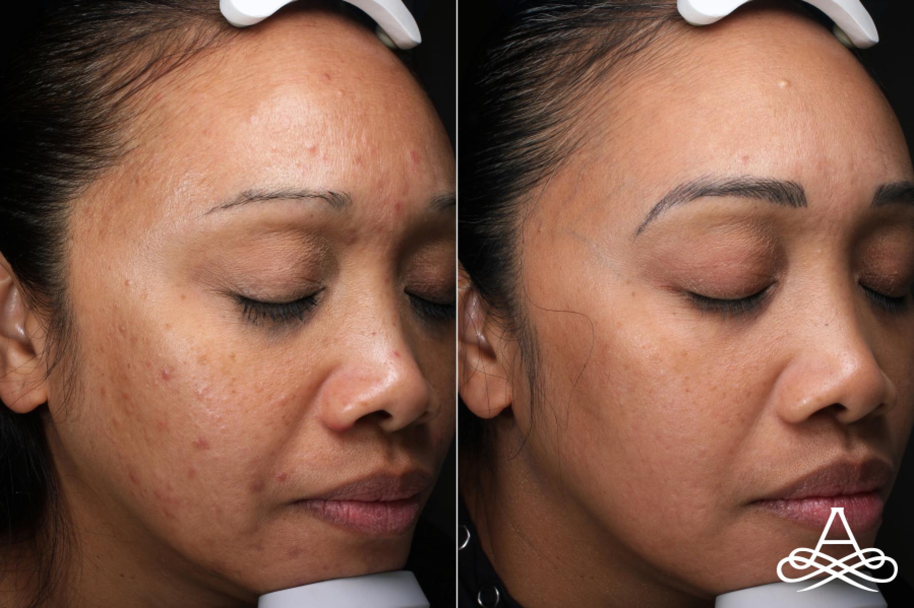 Acne Scars: Patient 2 - Before and After 3
