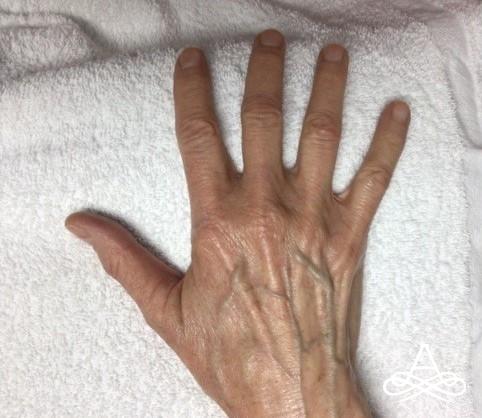 Hand Rejuvenation: Patient 1 - Before 