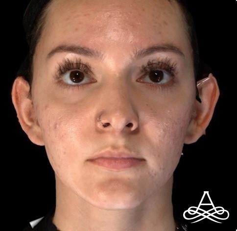 Otoplasty: Patient 2 - Before 