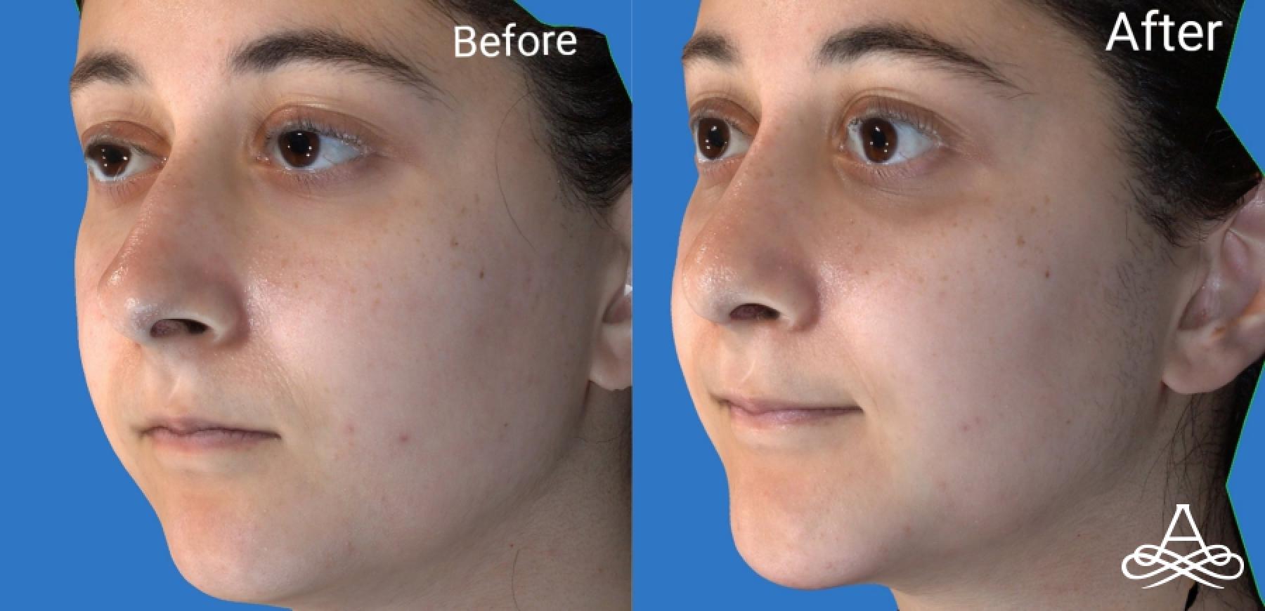 Rhinoplasty: Patient 3 - Before and After  