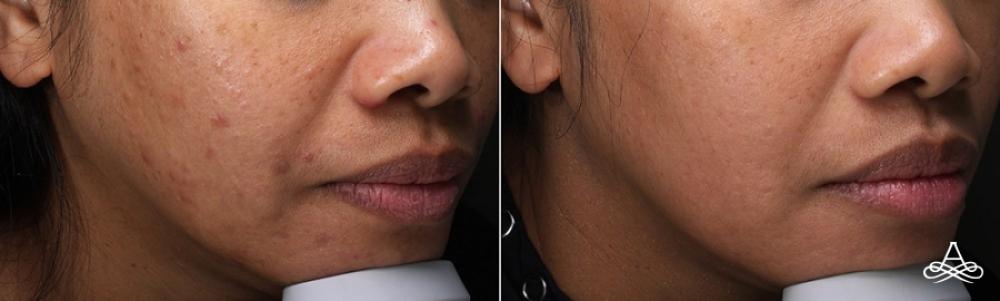 Acne Scars: Patient 2 - Before and After 4