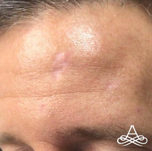 CO2 Laser Resurfacing: Patient 1 - Before 