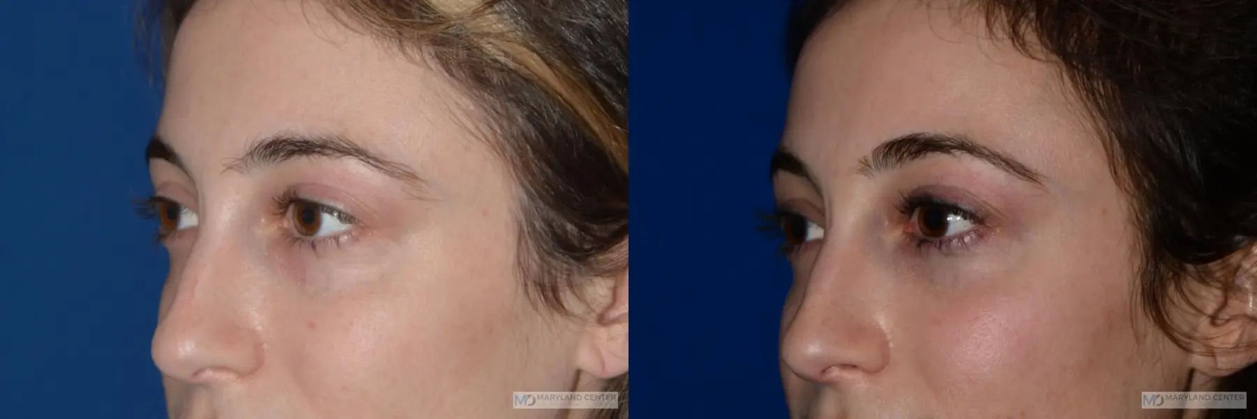 Blepharoplasty: Patient 5 - Before and After 2