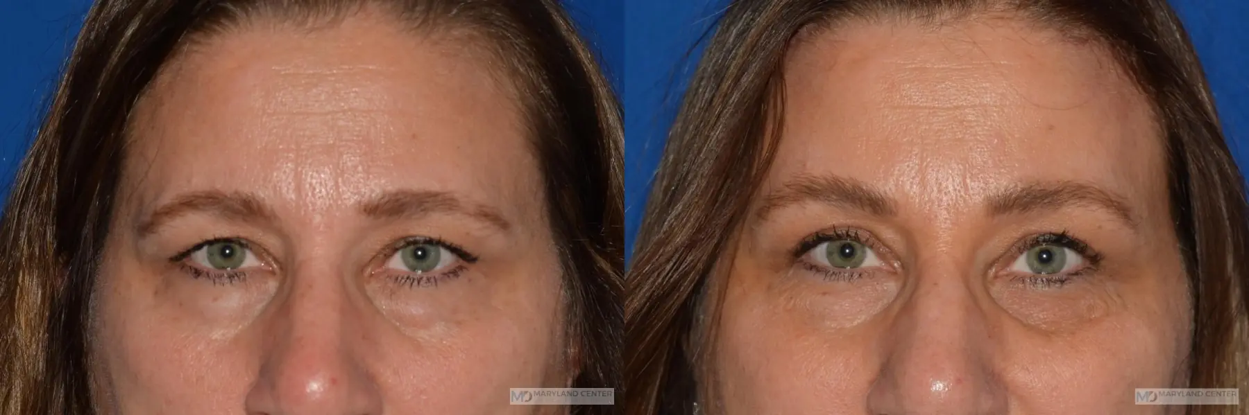 Blepharoplasty: Patient 2 - Before and After  