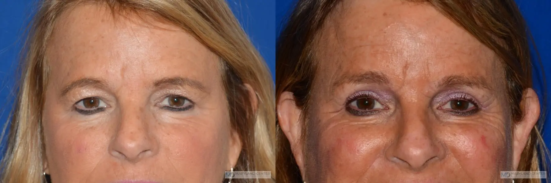 Blepharoplasty: Patient 3 - Before and After  