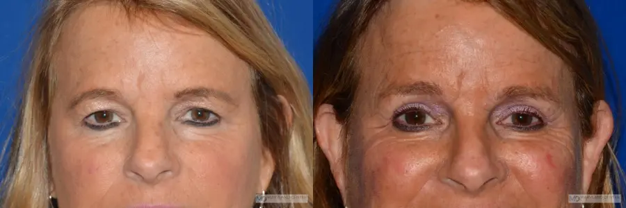 Blepharoplasty: Patient 3 - Before and After  