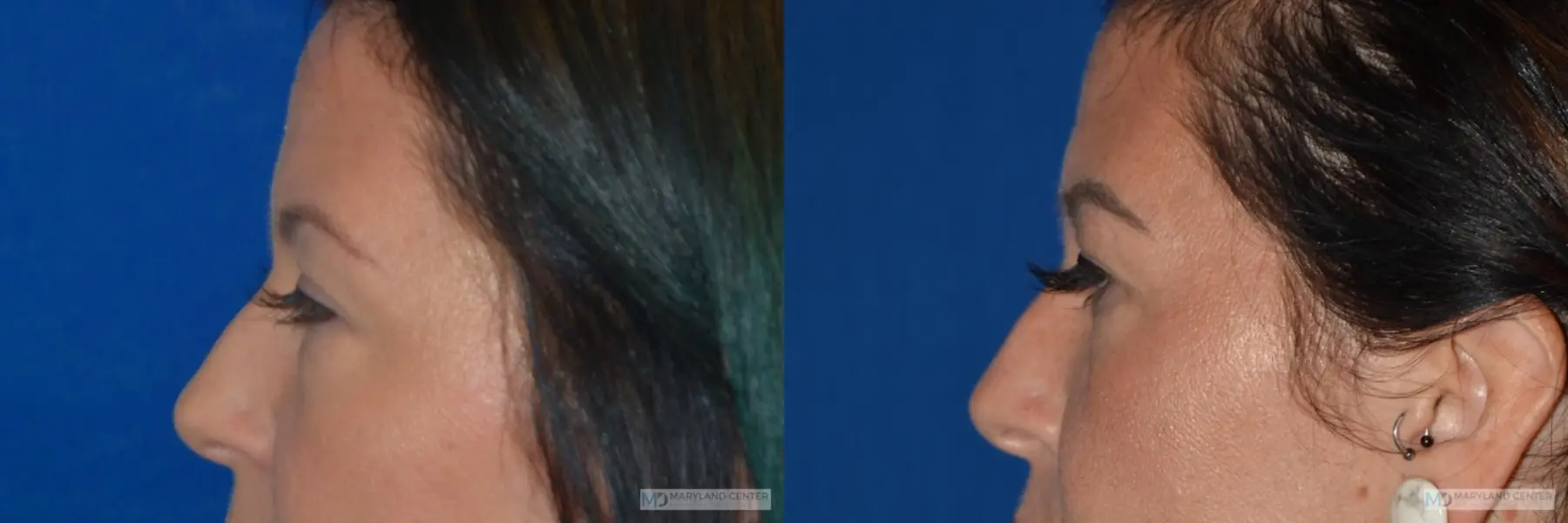 Blepharoplasty: Patient 1 - Before and After 2