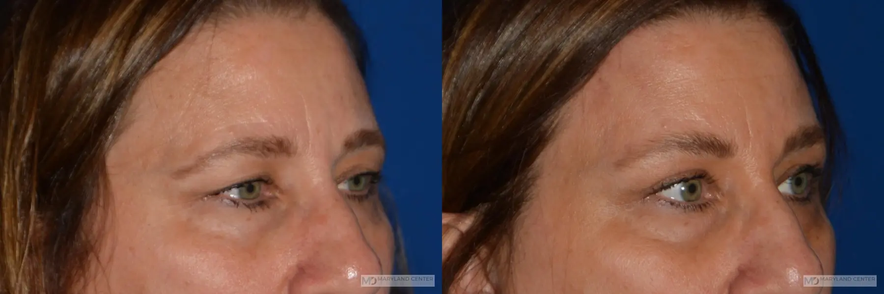 Blepharoplasty: Patient 2 - Before and After 2