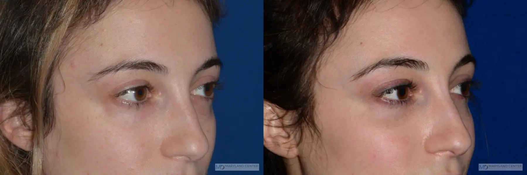Blepharoplasty: Patient 5 - Before and After 3