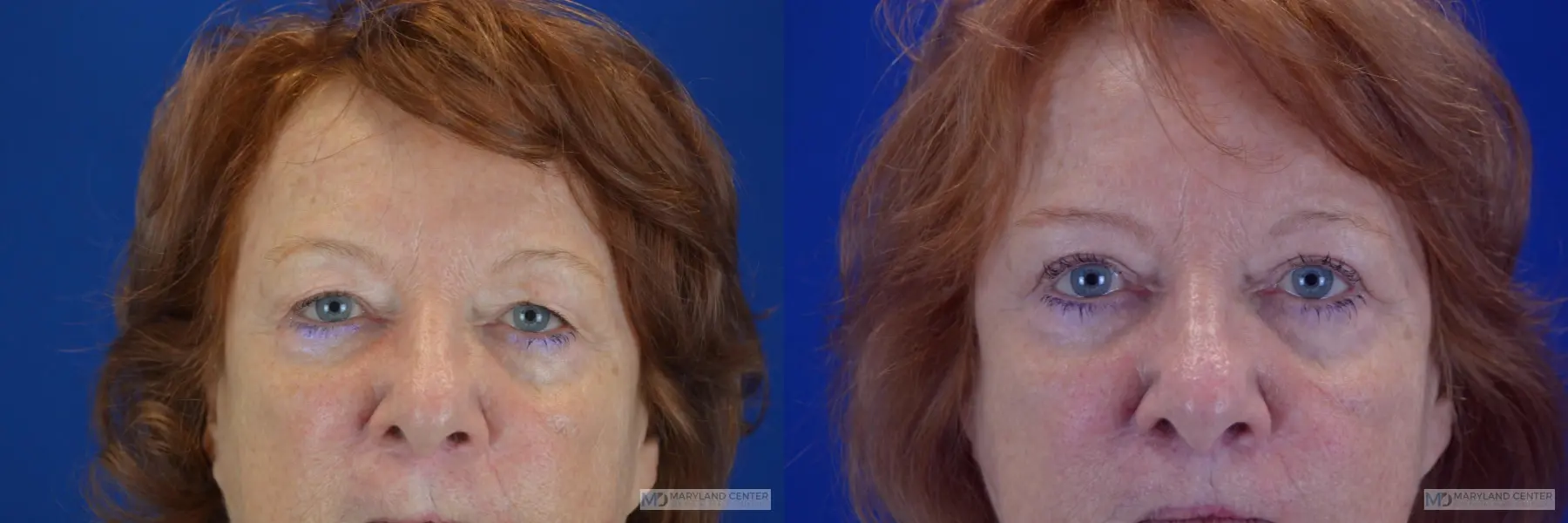 Blepharoplasty: Patient 4 - Before and After  