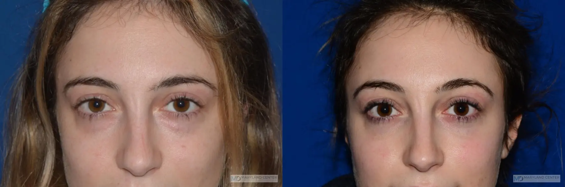 Blepharoplasty: Patient 5 - Before and After  