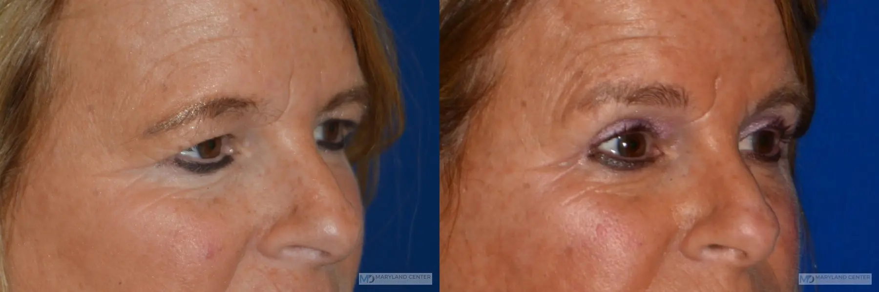 Blepharoplasty: Patient 3 - Before and After 3