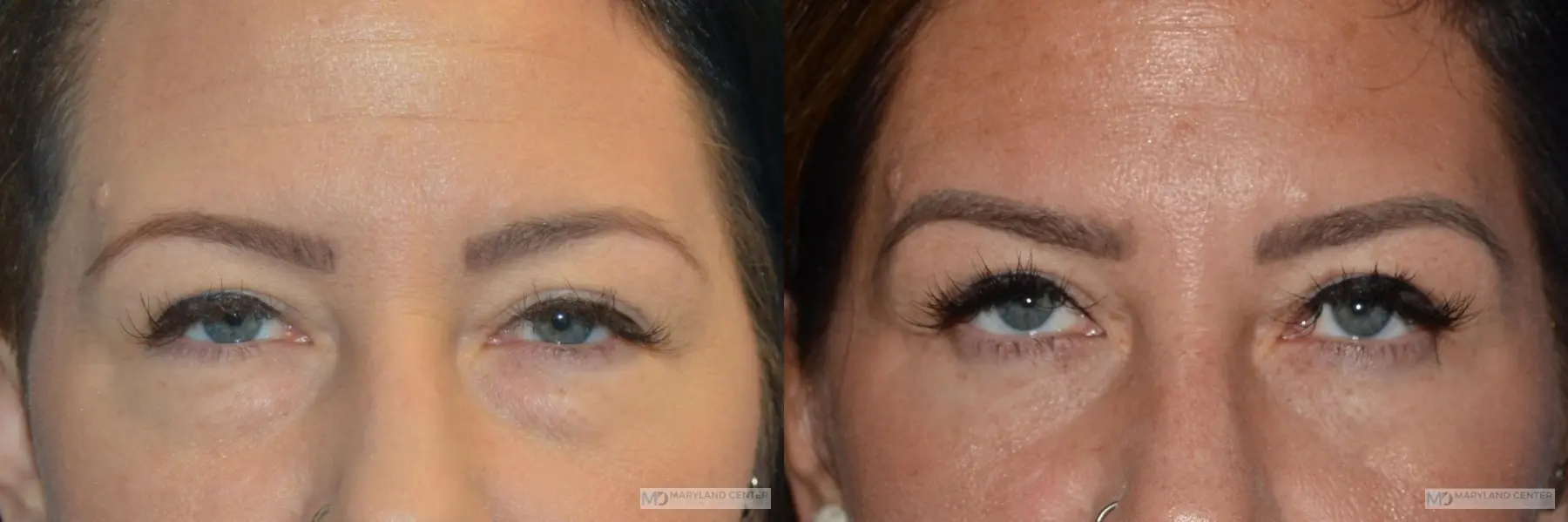 Blepharoplasty: Patient 1 - Before and After  