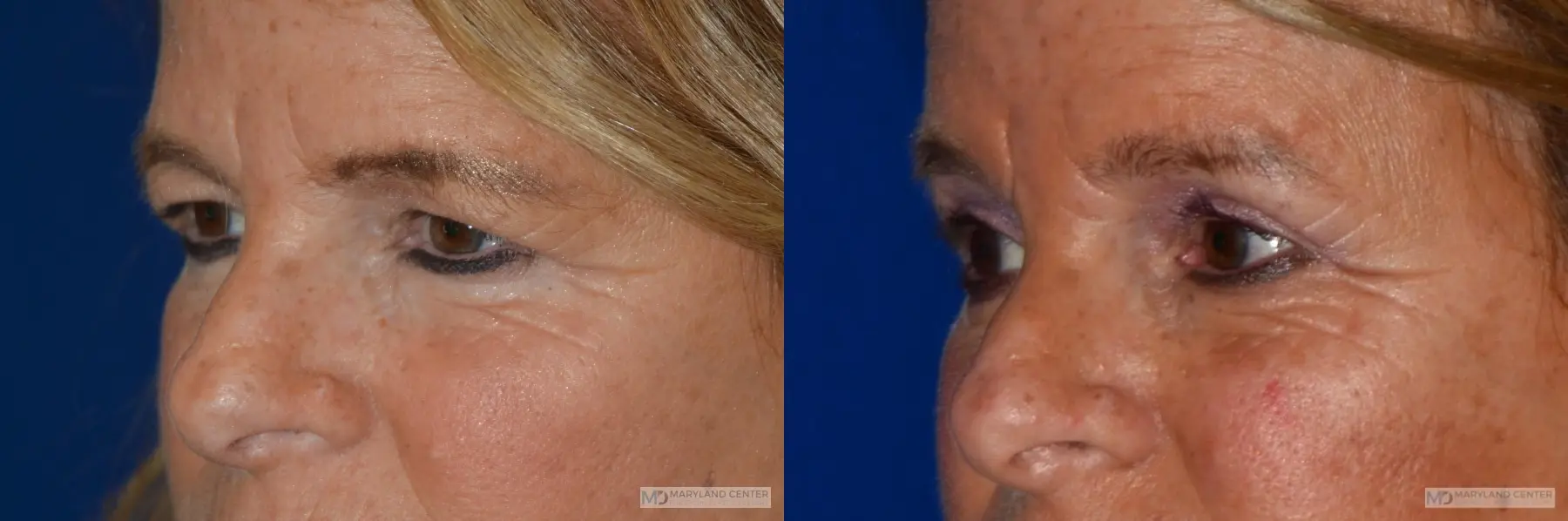 Blepharoplasty: Patient 3 - Before and After 2