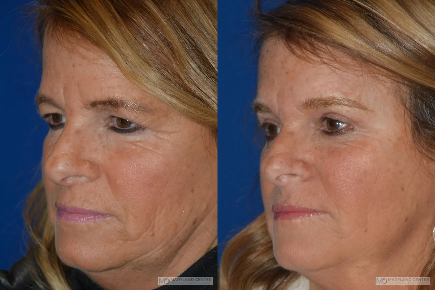 Brow Lift: Patient 1 - Before and After 3