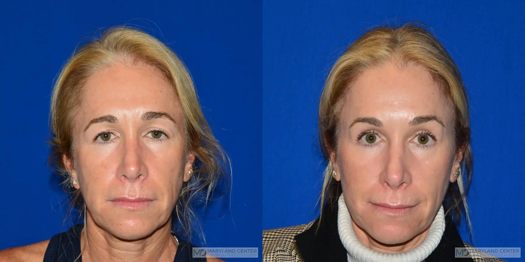 Brow Lift: Patient 3 - Before and After  