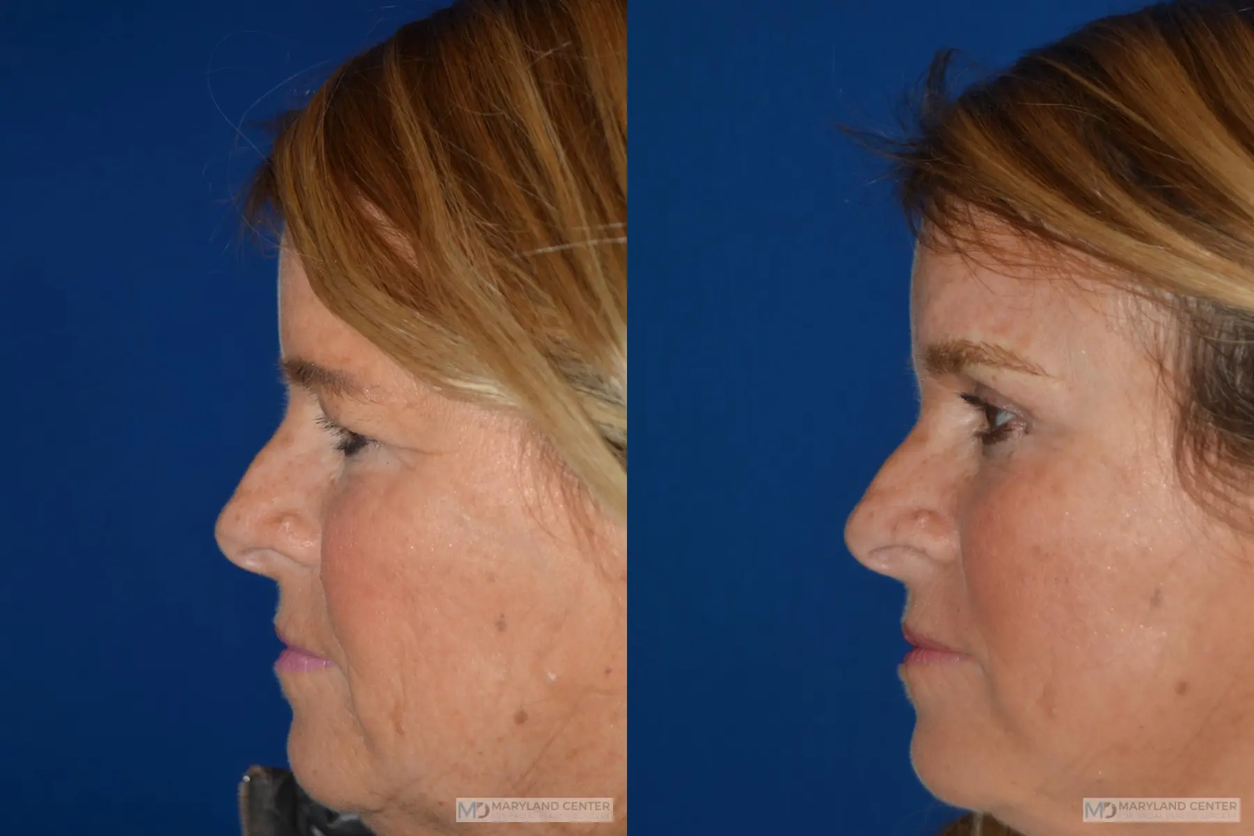 Brow Lift: Patient 1 - Before and After 2