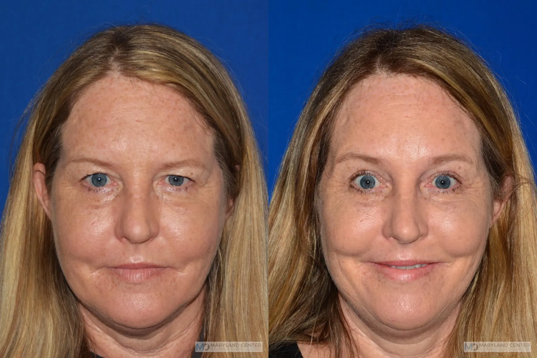 Brow Lift: Patient 2 - Before and After  