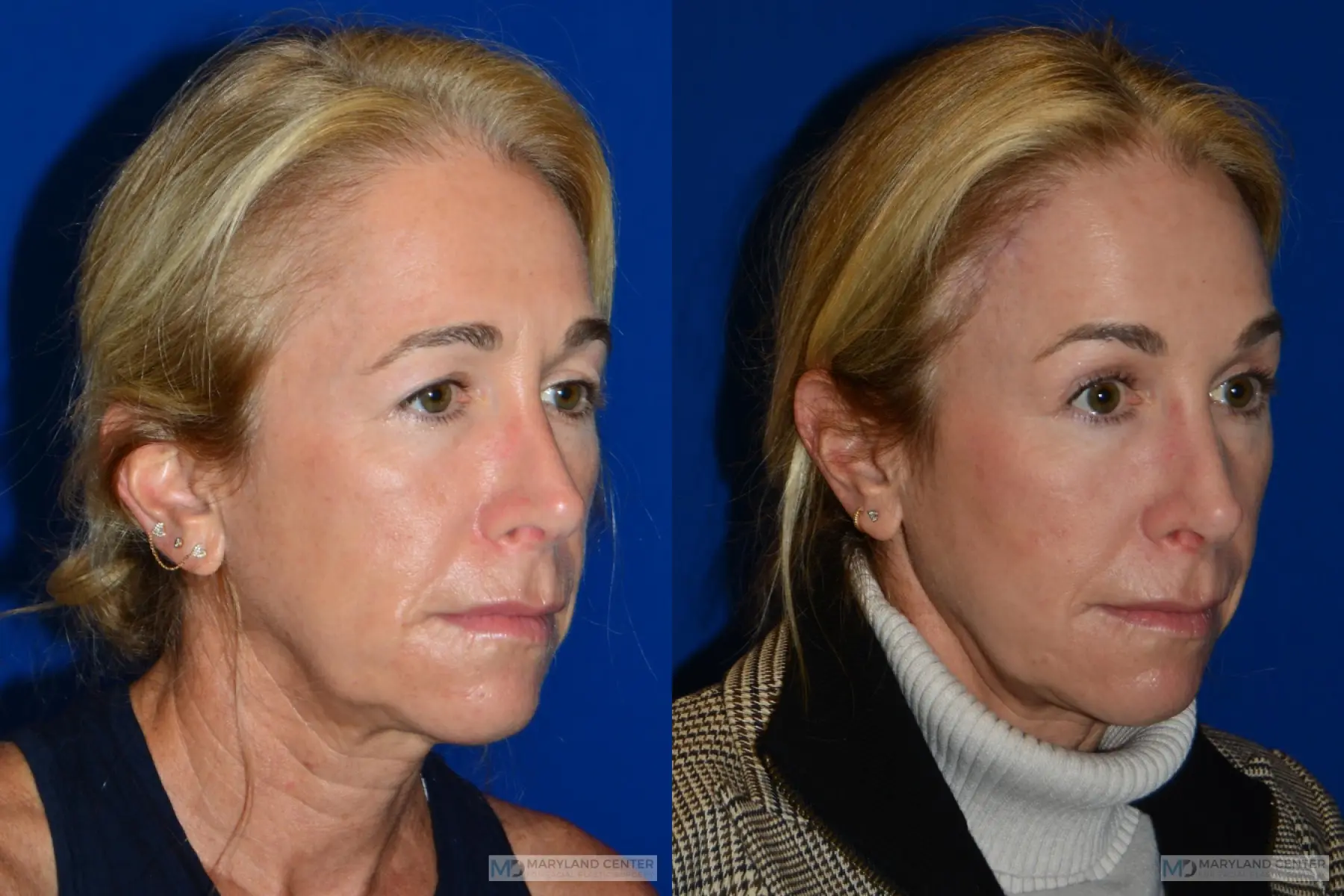 Brow Lift: Patient 3 - Before and After 2