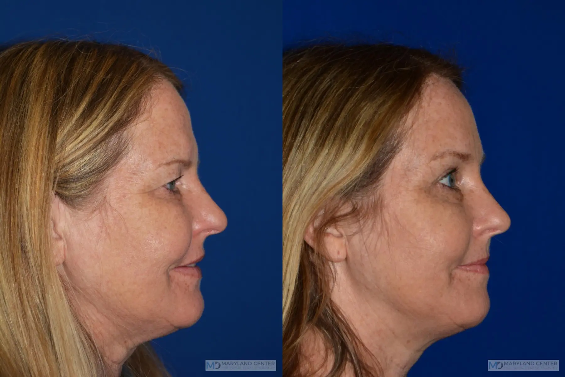 Brow Lift: Patient 2 - Before and After 2