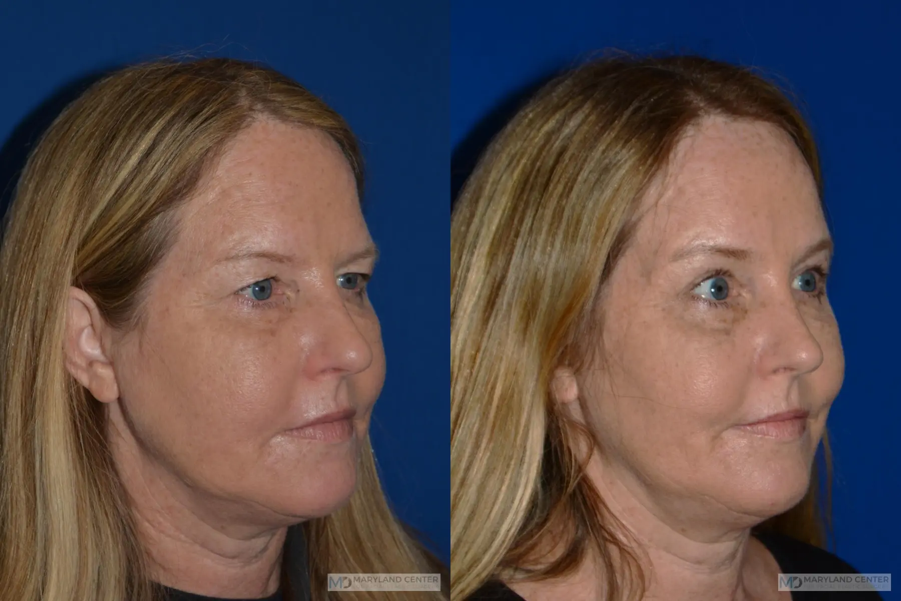 Brow Lift: Patient 2 - Before and After 3