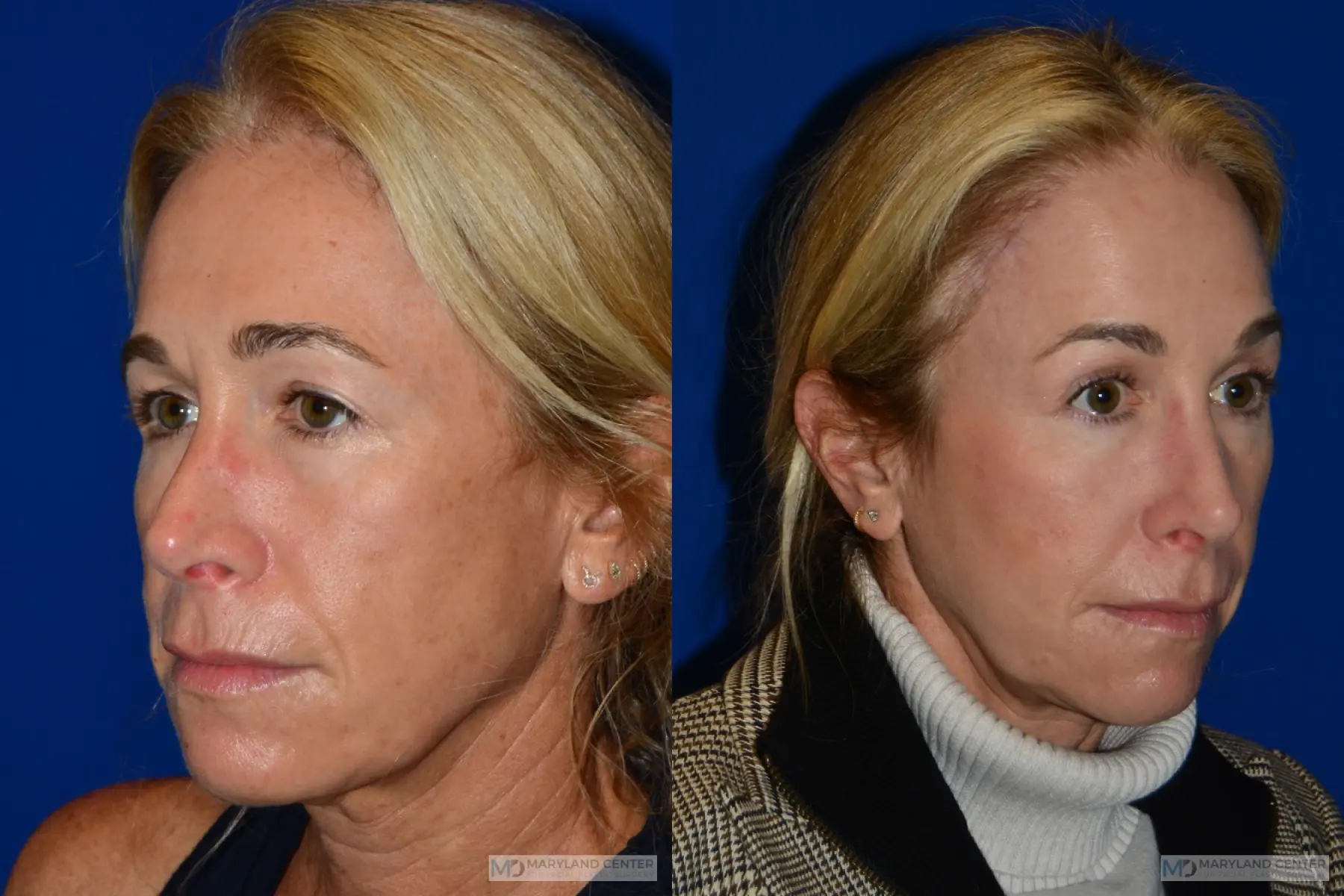 Brow Lift: Patient 3 - Before and After 3