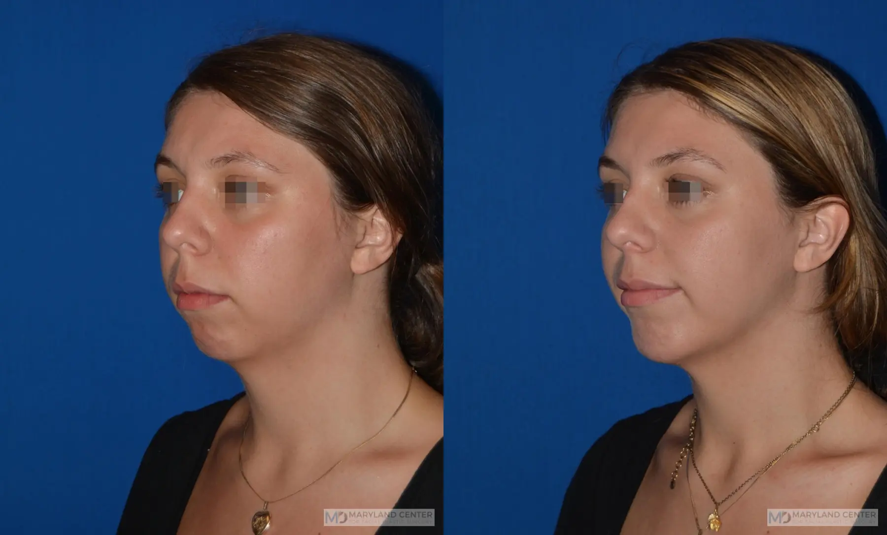 Chin Implant: Patient 2 - Before and After 3
