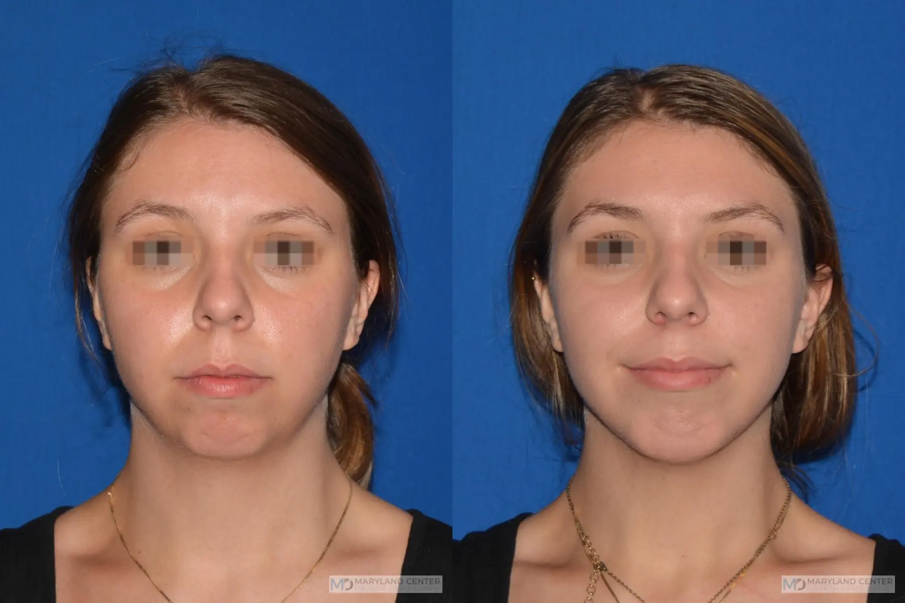Chin Implant: Patient 2 - Before and After  
