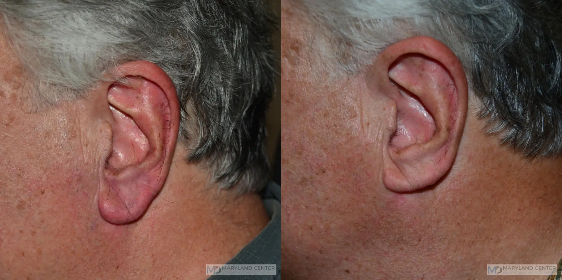 Earlobe Reduction: Patient 1 - Before and After  