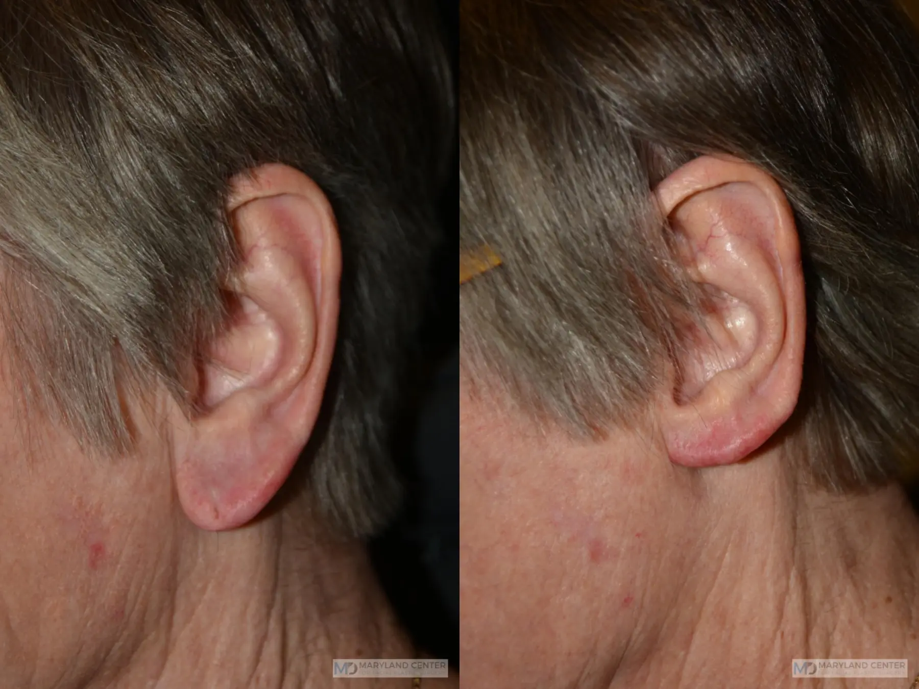 Earlobe Reduction: Patient 2 - Before and After  