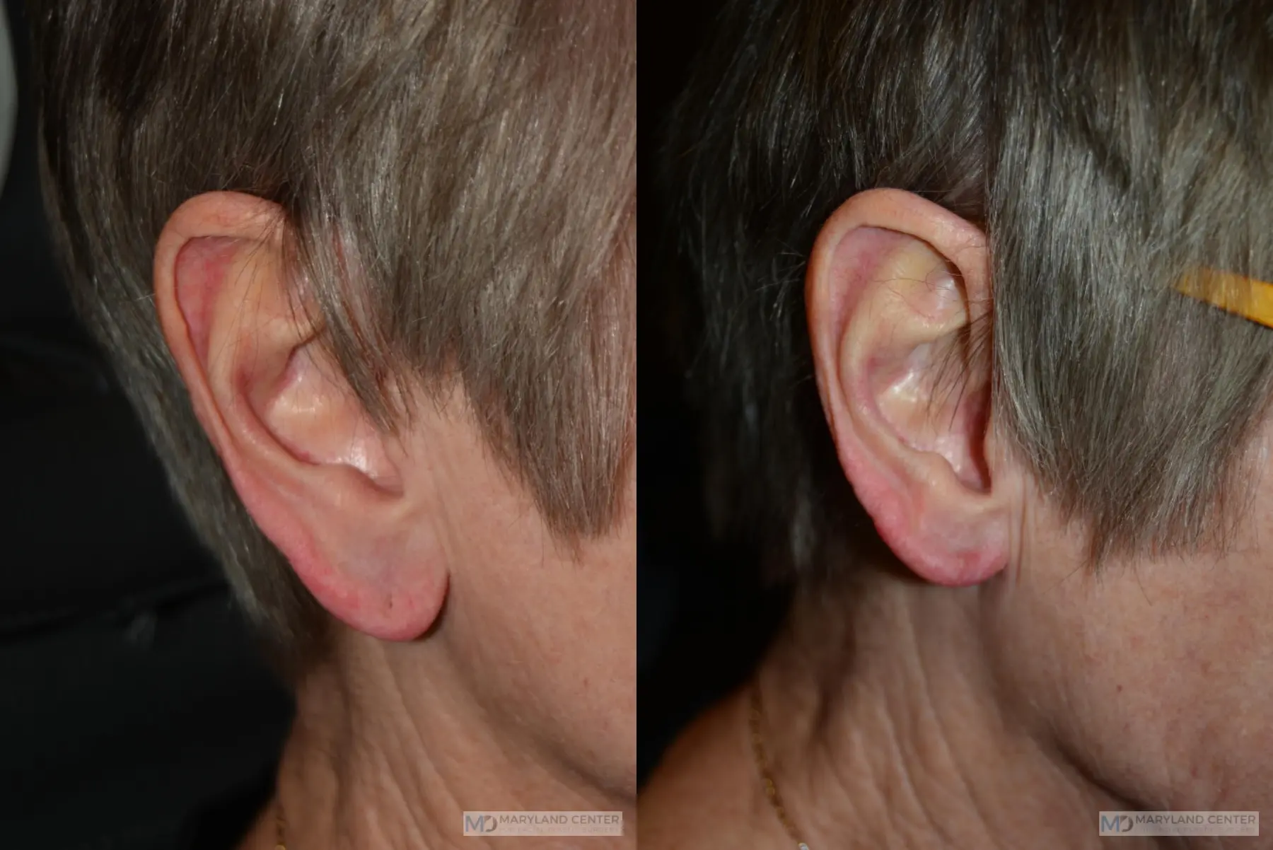 Earlobe Reduction: Patient 2 - Before and After 2