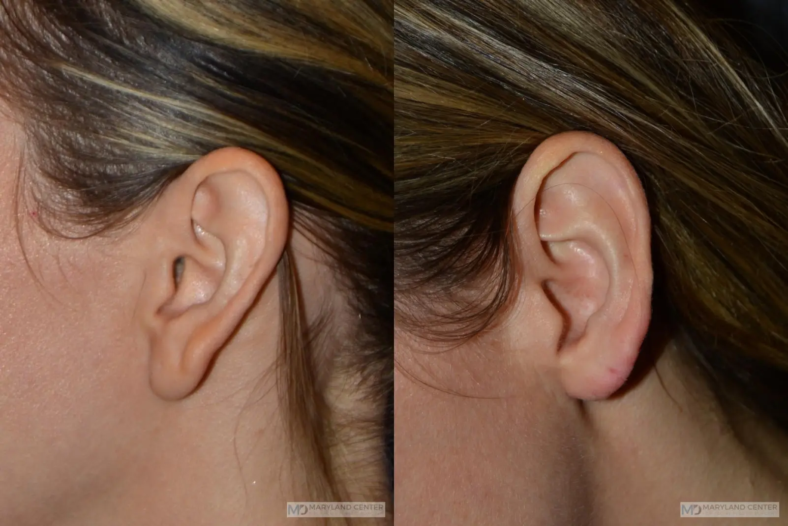 Earlobe Reduction: Patient 3 - Before and After  
