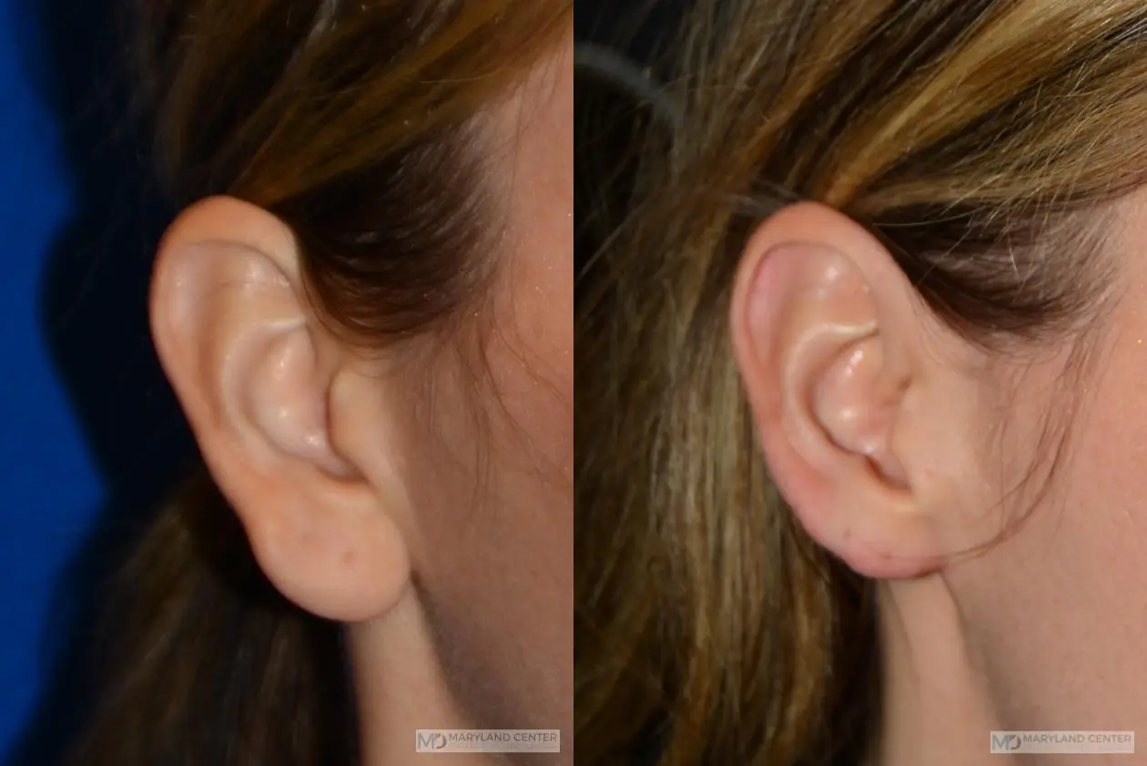 Earlobe Reduction: Patient 3 - Before and After 2