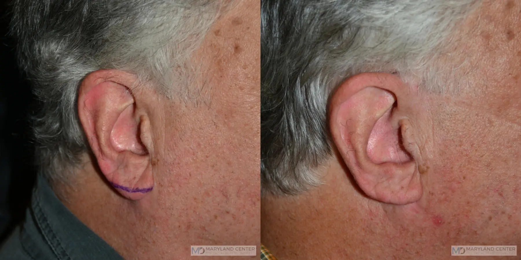 Earlobe Reduction: Patient 1 - Before and After 2