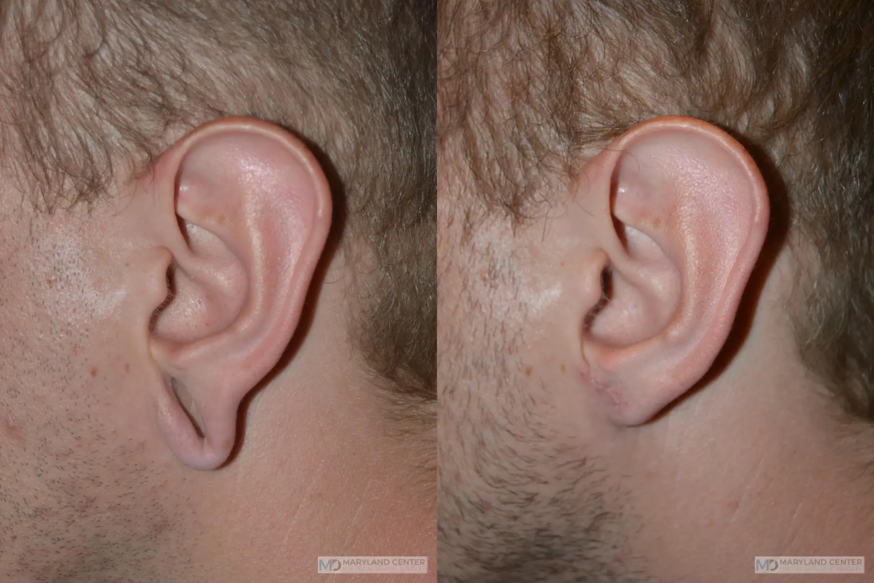 Earlobe Repair: Patient 2 - Before and After 1