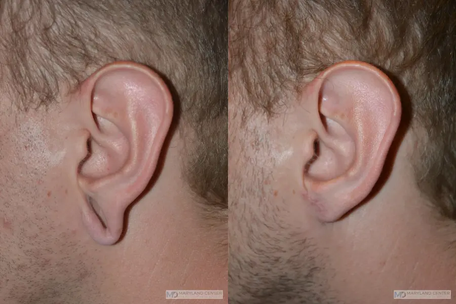 Earlobe Repair: Patient 2 - Before and After  
