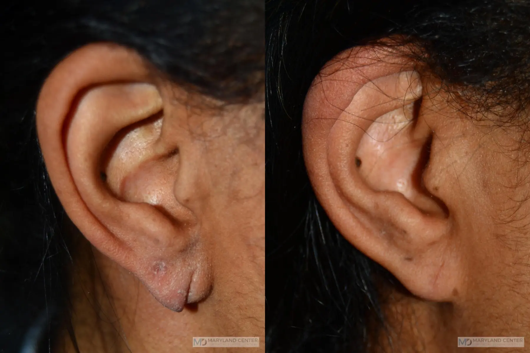 Earlobe Repair: Patient 1 - Before and After  